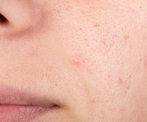 علاج مسامات الوجه