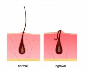 علاج الشعر تحت الجلد
