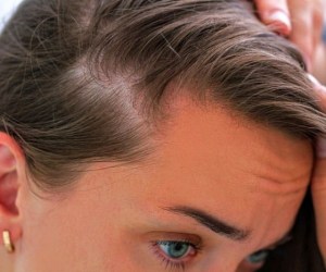 تساقط شعر النساء