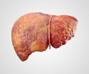 علاج الكبد الدهني