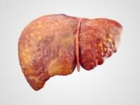 علاج الكبد الدهني